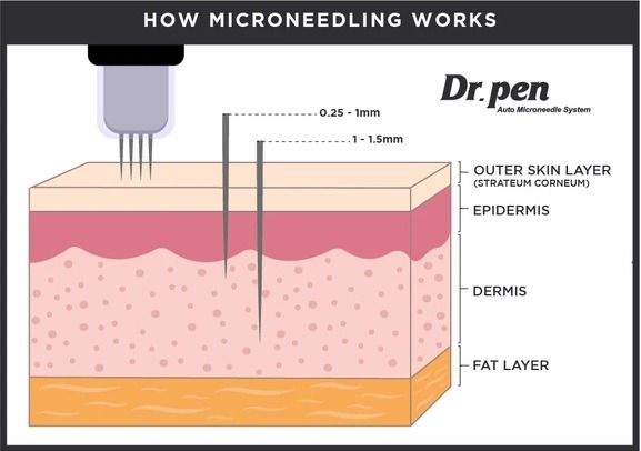 how to microneedling works